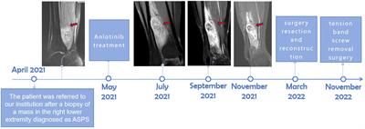 Case report: Individualized 3D-printed uncemented distal fibular prosthesis preserving the lateral malleolus for repair of distal fibular defects